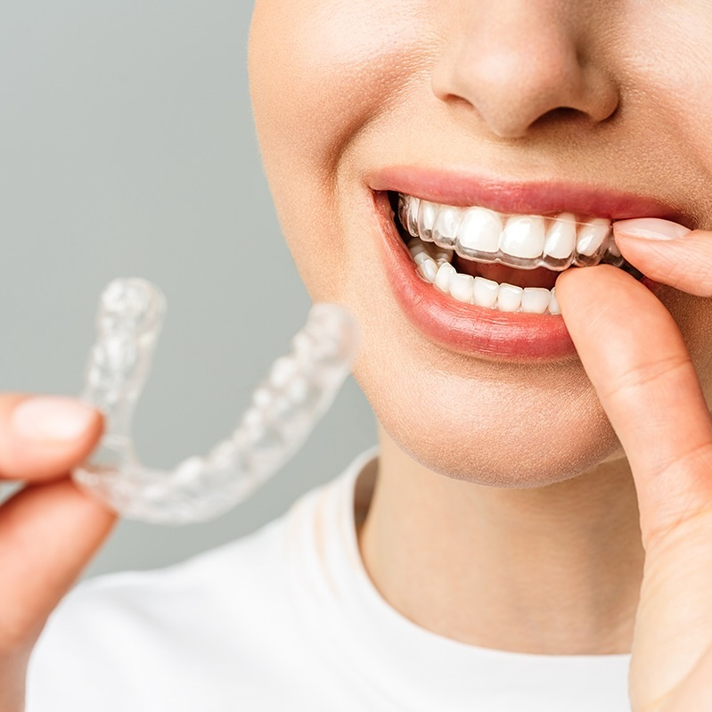Invisalign clear aligners